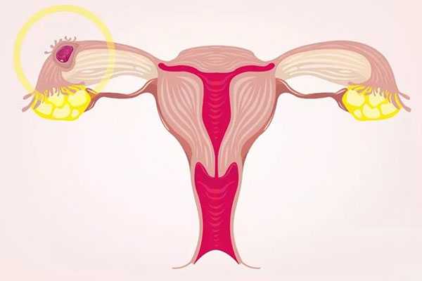 生化妊娠的症状有那些 生化妊娠产生的原因